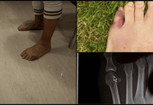 Conor McGregor toe injury